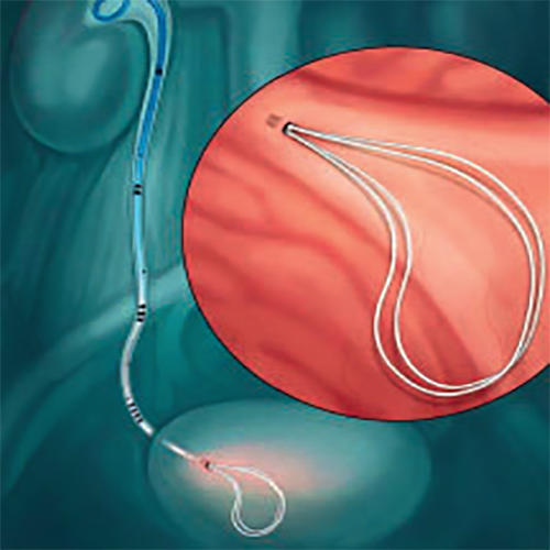 Изображение СТЕНТ МОЧЕТОЧНИКОВЫЙ POLARIS LOOP