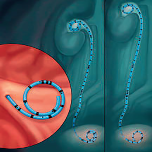 Изображение СТЕНТ МОЧЕТОЧНИКОВЫЙ УНИВЕРСАЛЬНОЙ ДЛИНЫ CONTOUR VL