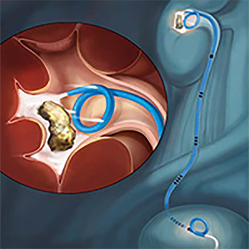 Изображение СТЕНТ МОЧЕТОЧНИКОВЫЙ УНИВЕРСАЛЬНОЙ ДЛИНЫ CONTOUR VL INJECTION