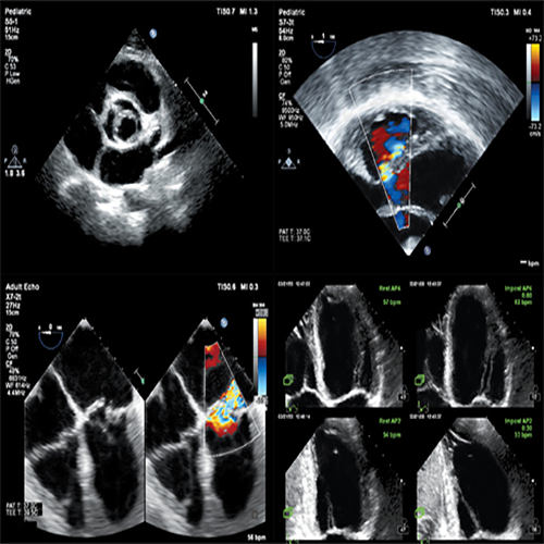 Изображение УЛЬТРАЗВУКОВОЙ АППАРАТ EPIQ5
